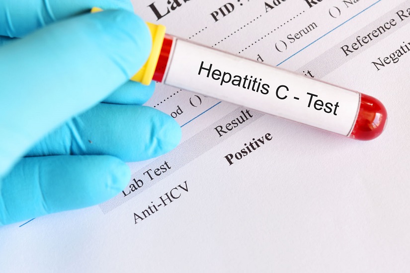 آزمایش تشخیص هپاتیت C
